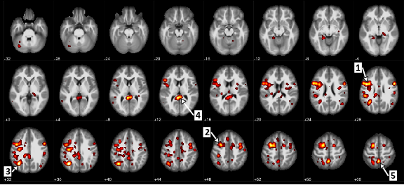 Des scanners cérébraux réalisés sur des patients schizophrènes